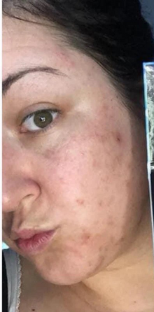 Before - Résultats après 18 jours