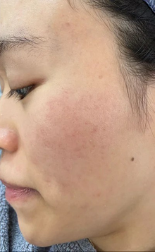 After - Résultats après 1 mois