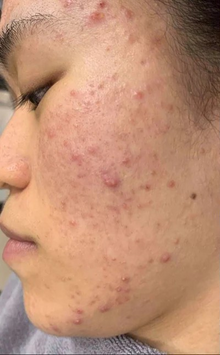 Before - Résultats après 1 mois